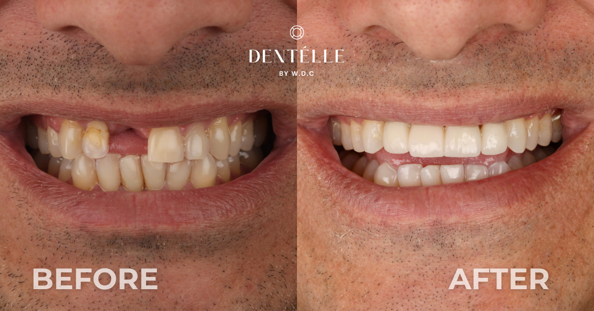 Ceramic Crowns Vs Dentures Clinical Case In Warragul
