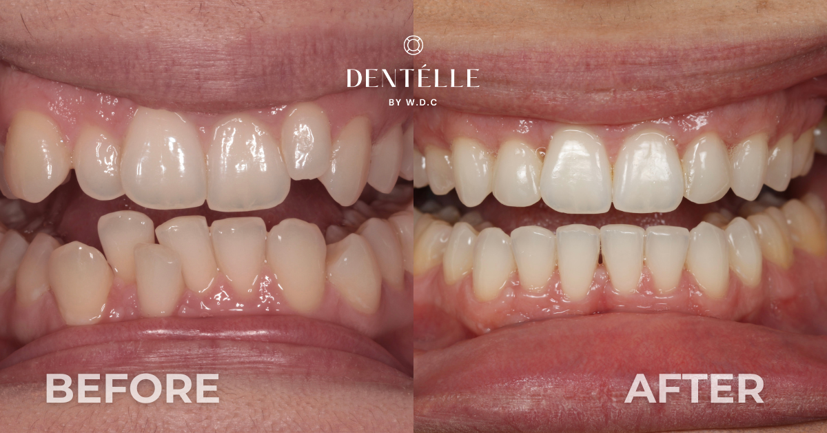 Complete Smile Makeover With Braces & Veneers Clinical Case In Warragul