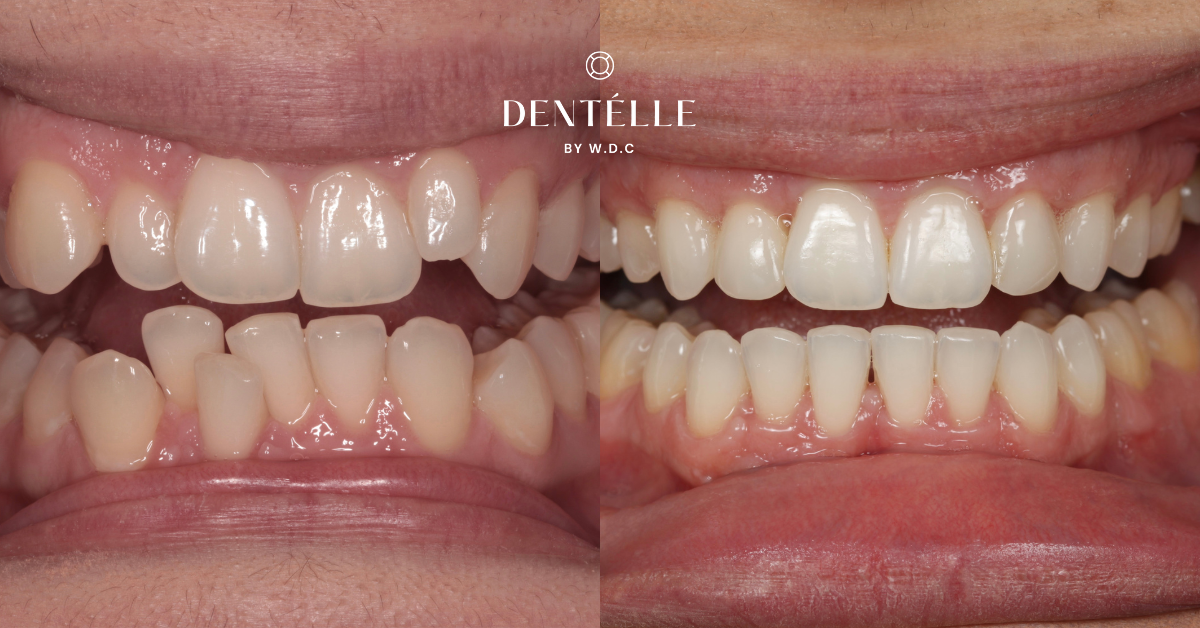 Complete Smile Makeover with Braces & Veneers Clinical Case in Warragul