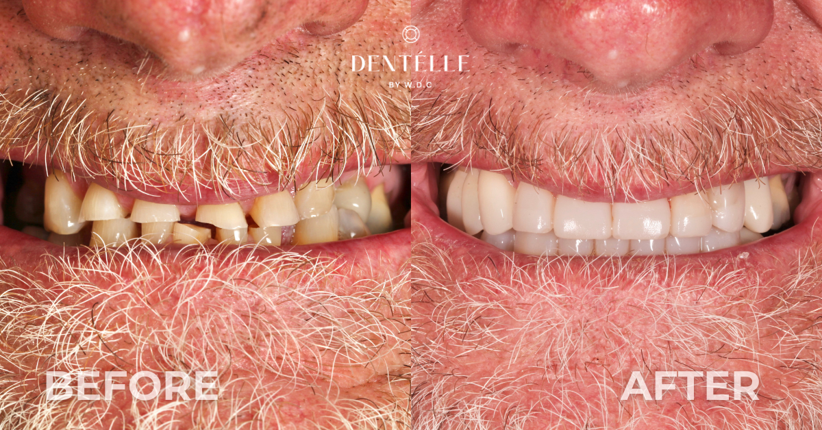 Comprehensive Smile Rehabilitation Clinical Case In Warragul