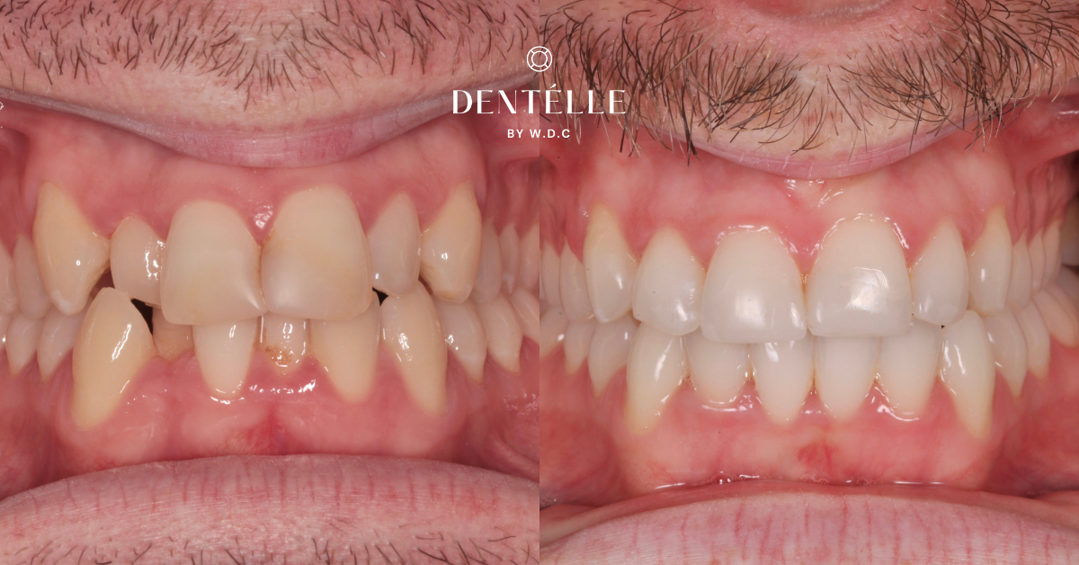 Orthodontics with Cosmetic Dentistry Clinical Case in Warragul