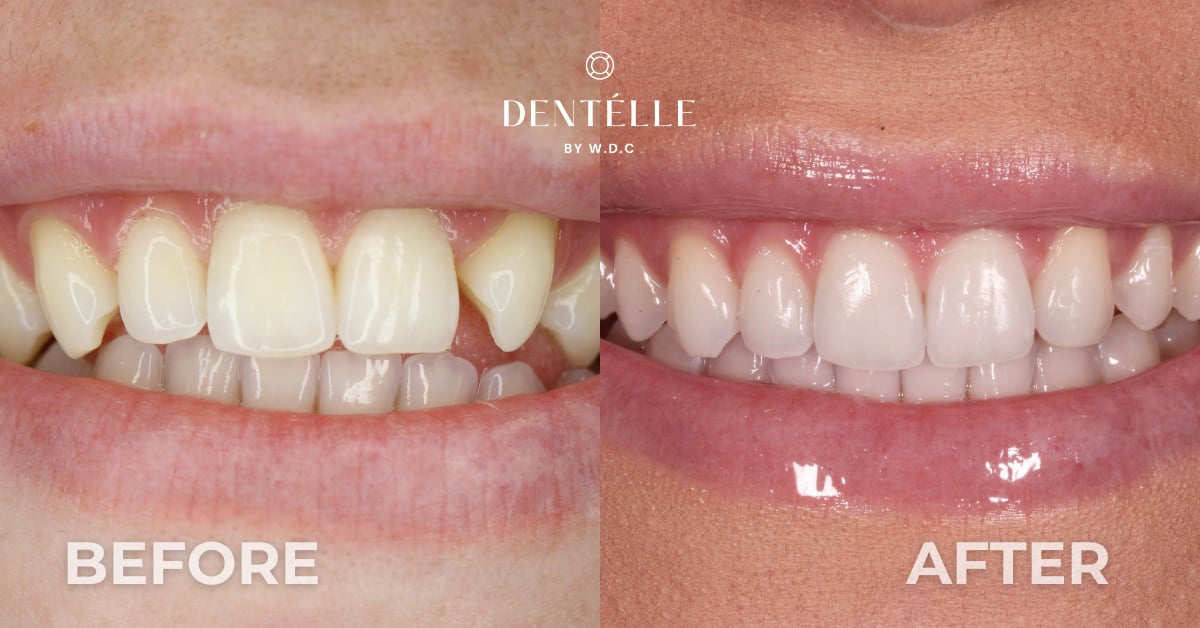 Orthodontic Treatment for Missing Tooth Warragul