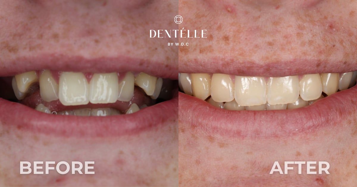 Invisalign for Crooked Teeth Warragul
