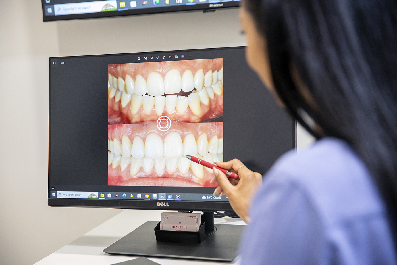 Wedding Teeth Whitening in Warragul: When to Start