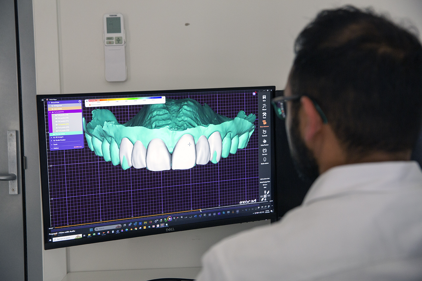 CEREC Same Day Crowns: What to Expect