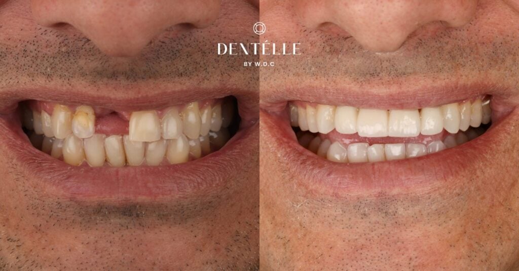 Ceramic Crowns Vs Dentures Clinical Case In Warragul