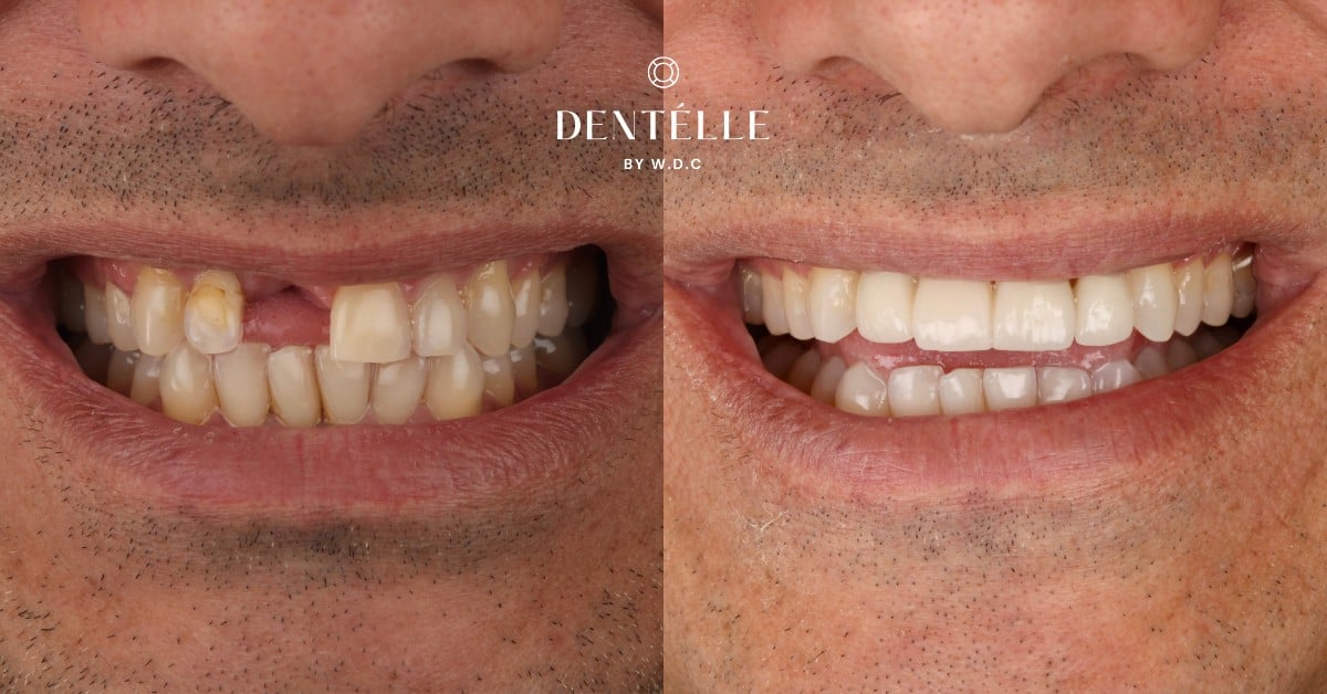 Ceramic Crowns Vs Dentures Clinical Case In Warragul