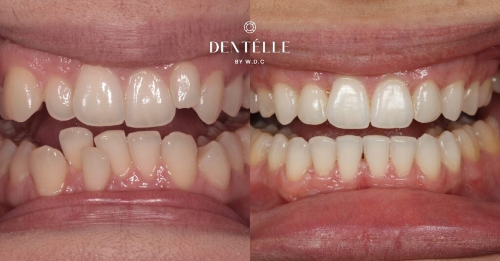Complete Smile Makeover With Braces & Veneers Clinical Case In Warragul