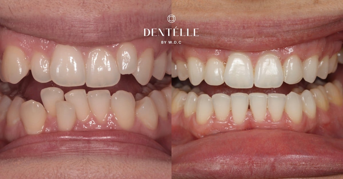 Complete Smile Makeover With Braces & Veneers Clinical Case In Warragul