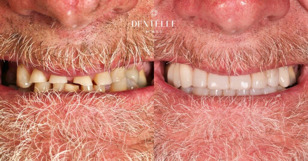 Comprehensive Smile Rehabilitation Clinical Case In Warragul