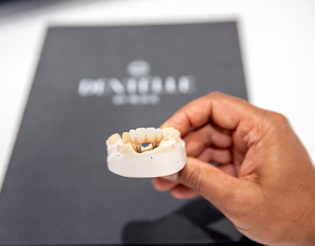 Dental Implant In Warragul, Gippsland In Dentélle By Wdc